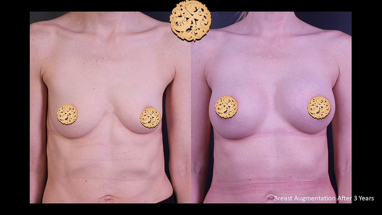 Breast Augmentation Before & After