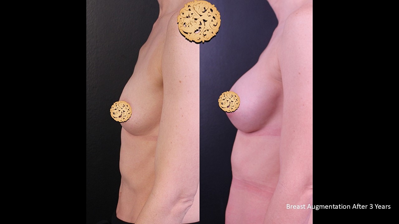 Breast Augmentation Before & After