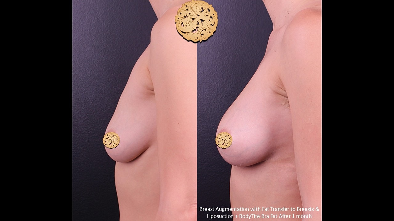 Breast Augmentation Before & After