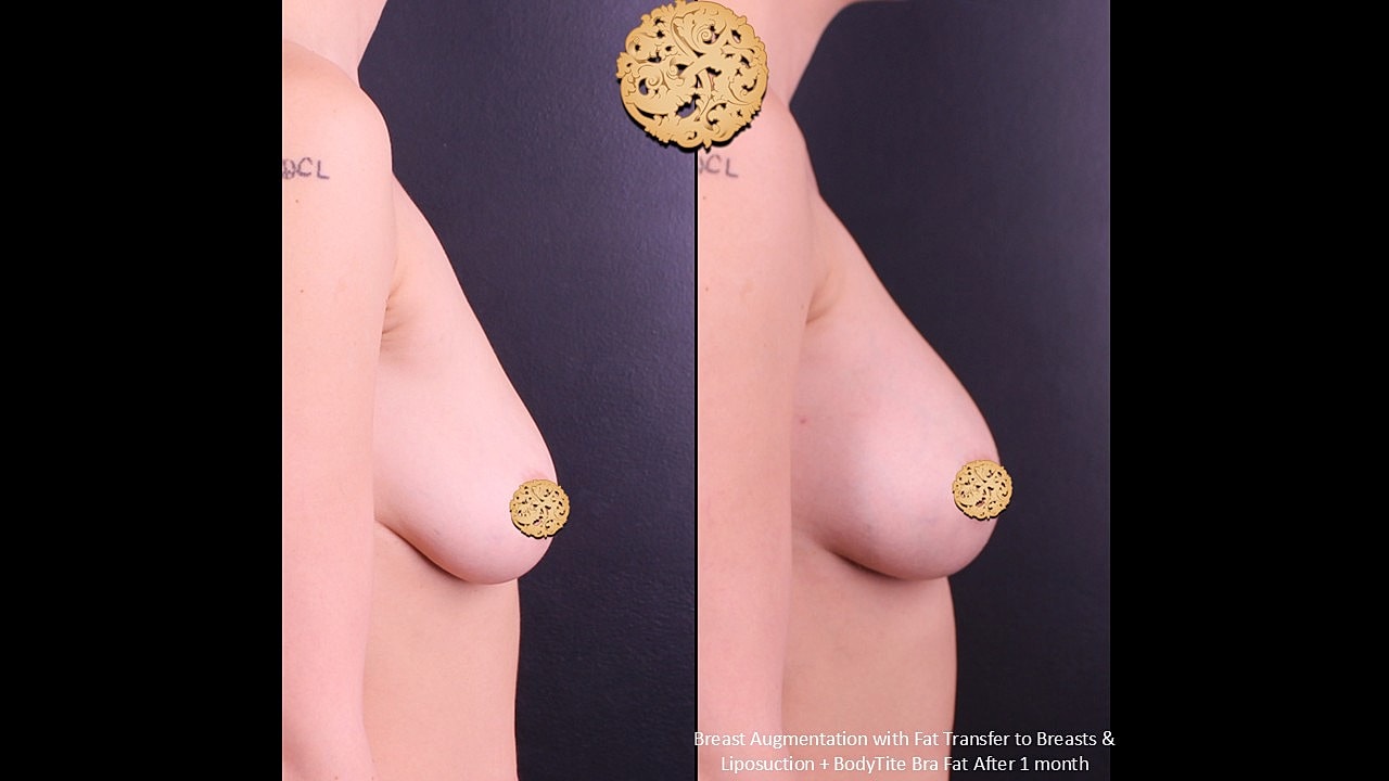 Breast Augmentation Before & After