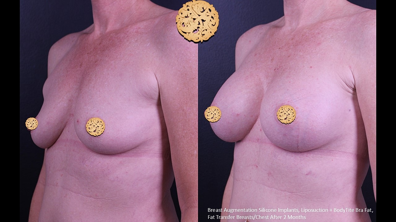 Comparison of breast augmentation results after two months.