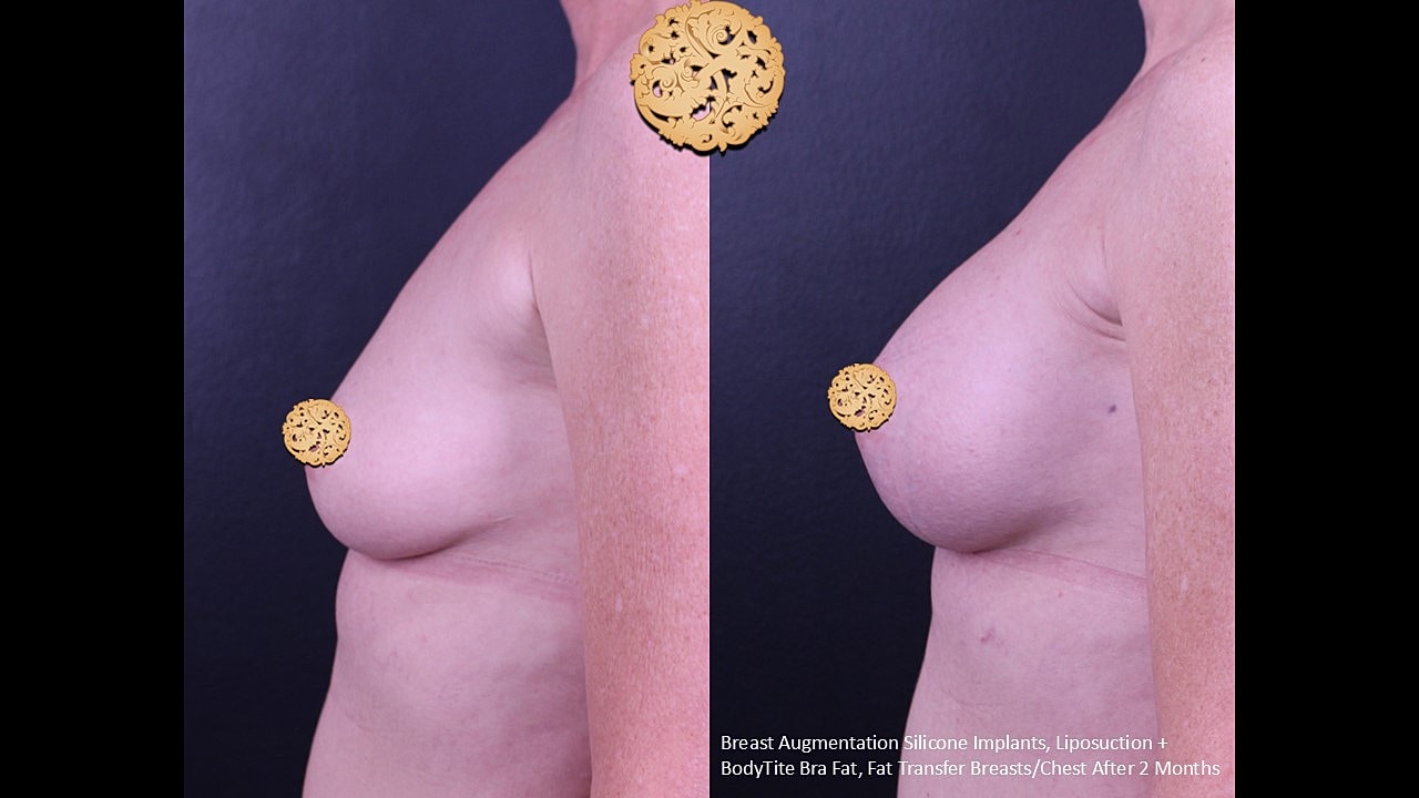 Breast augmentation results after two months.