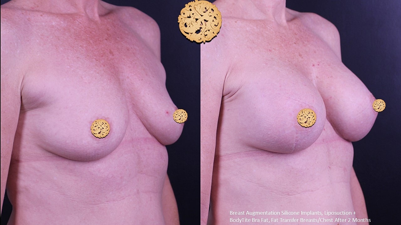 Before and after breast augmentation results.