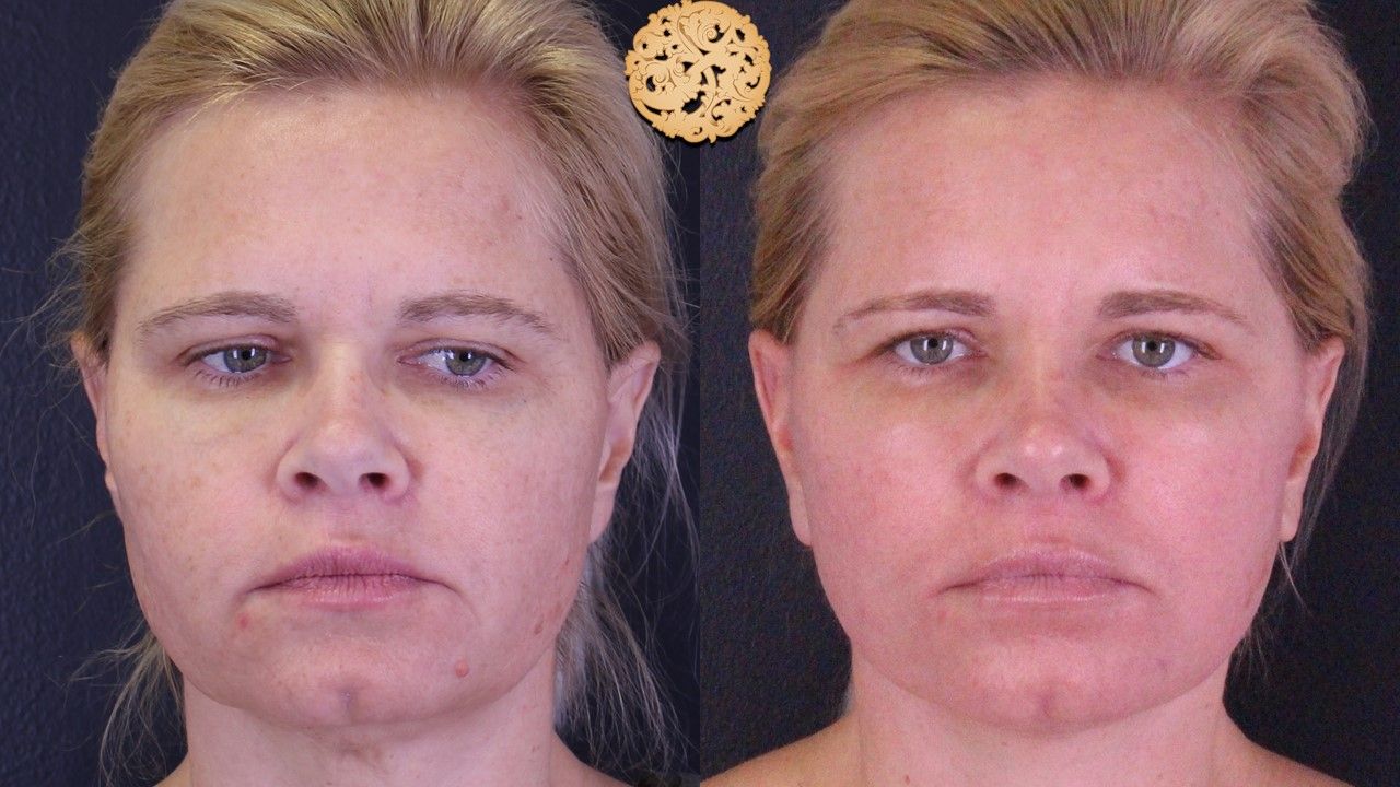 Microlaser Peel Before & After