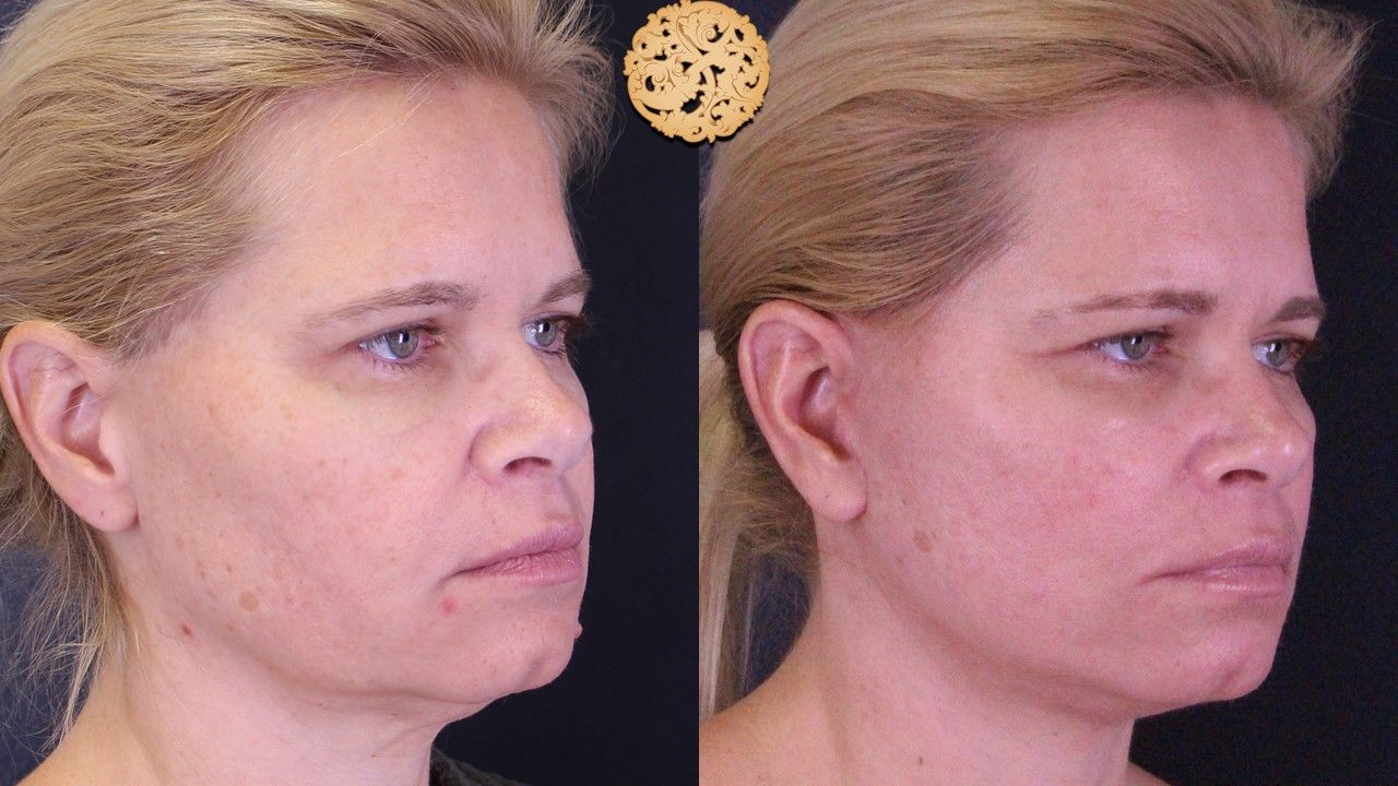 Microlaser Peel Before & After