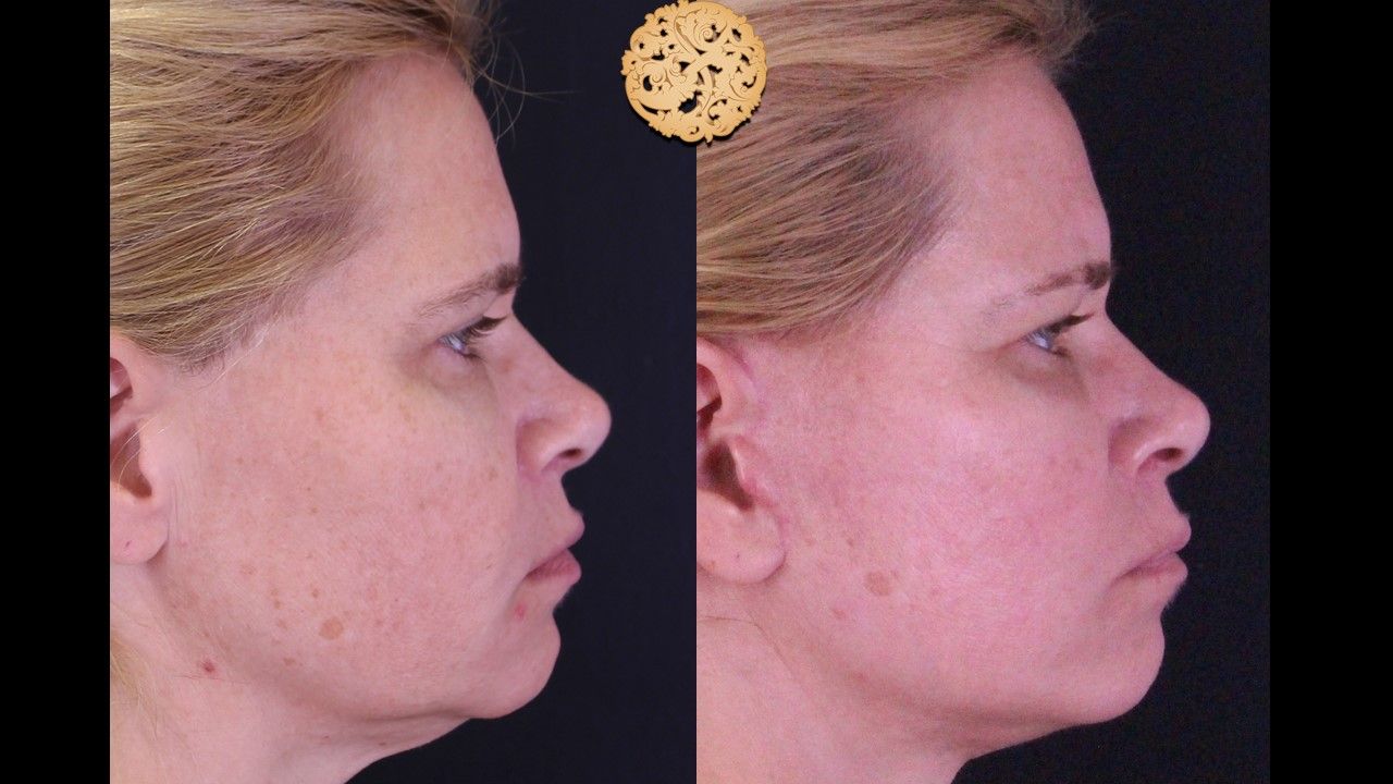 Microlaser Peel Before & After