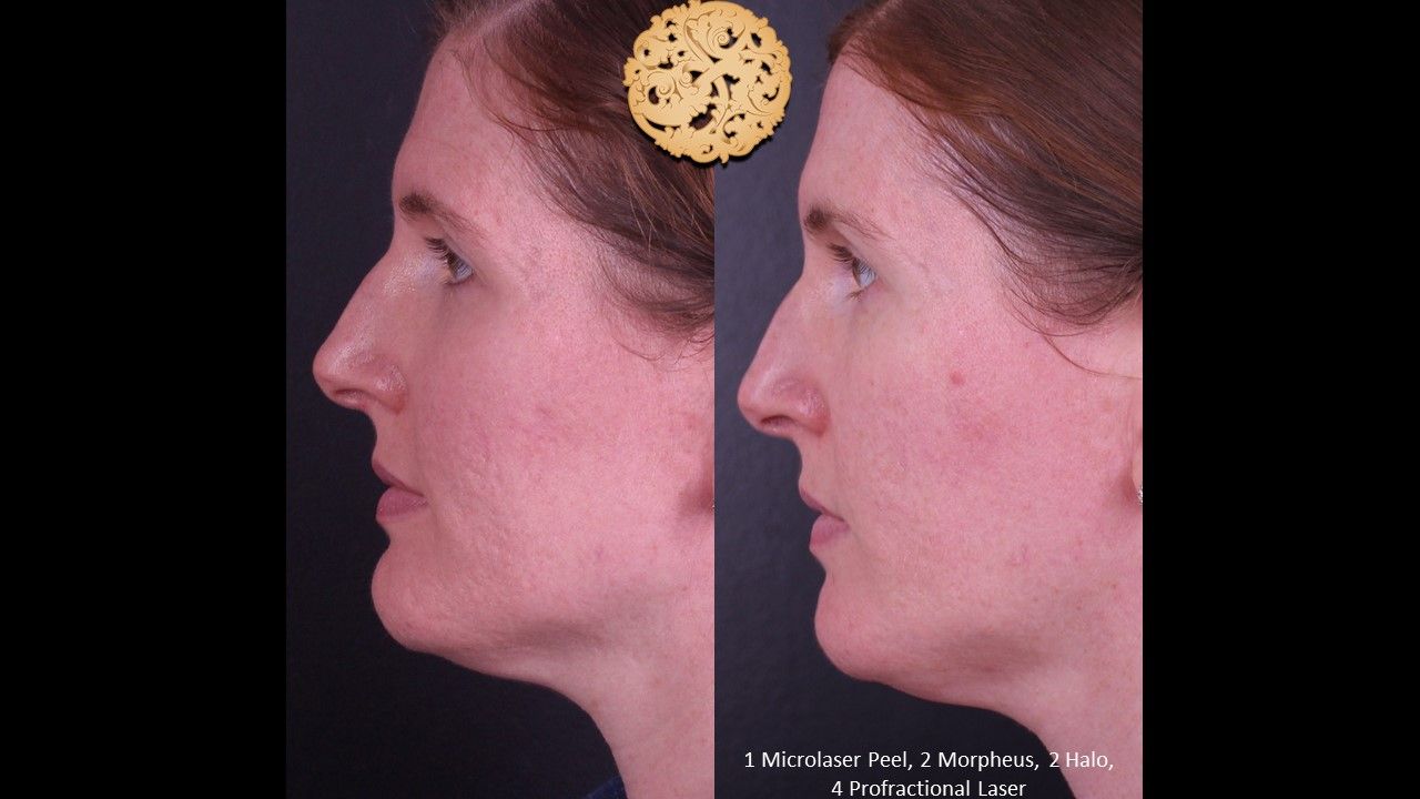 Microlaser Peel Before & After