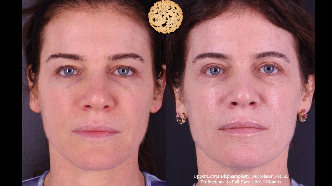 Microlaser Peel Before & After