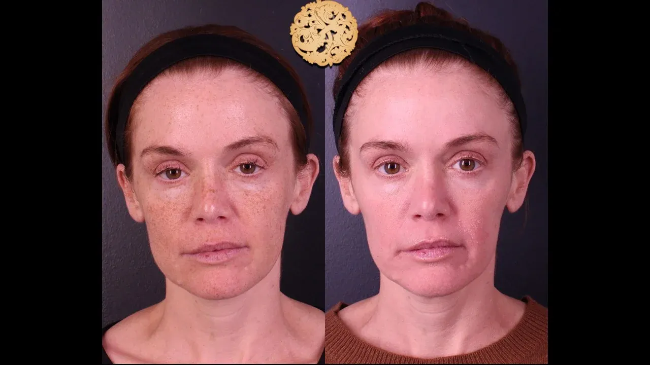 Microlaser Peel Before & After