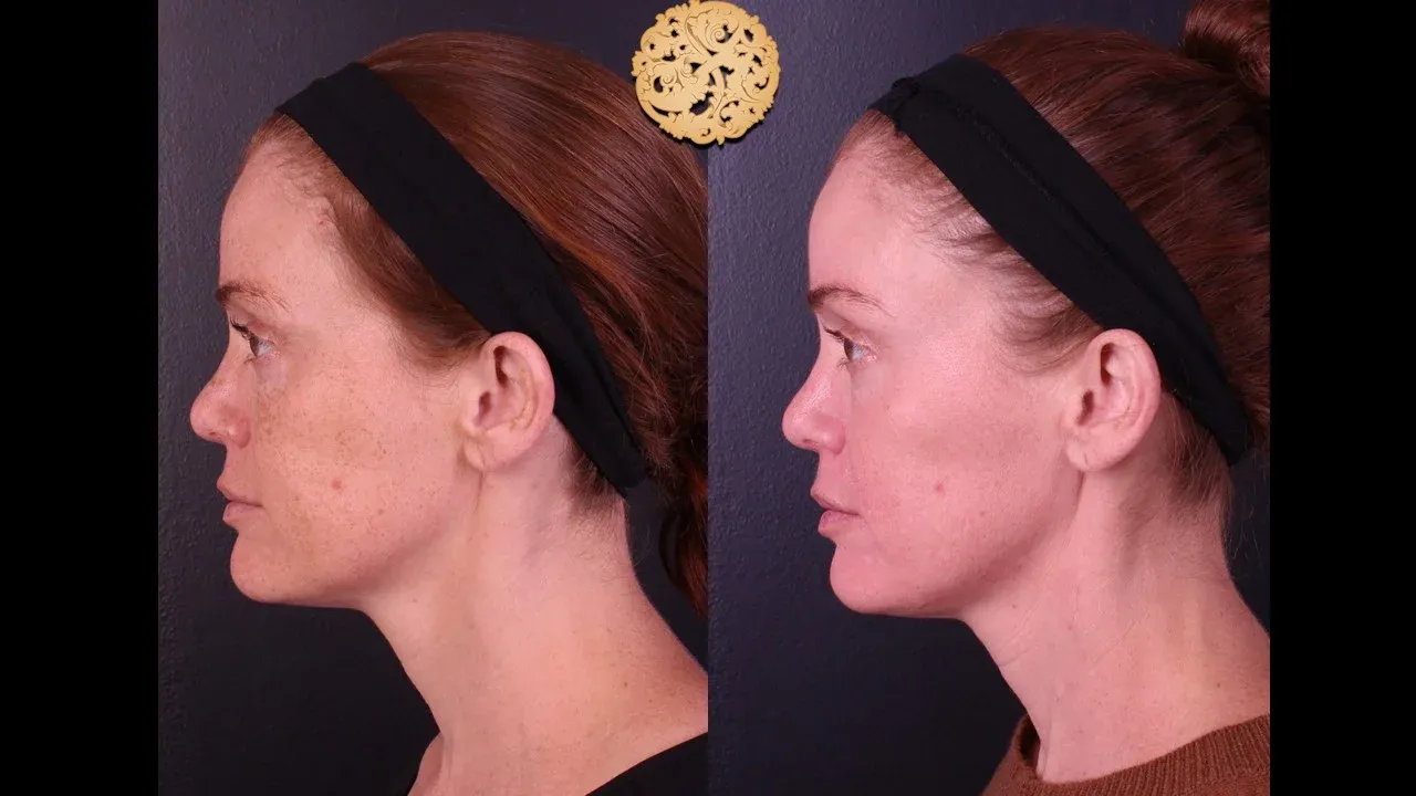 Microlaser Peel Before & After