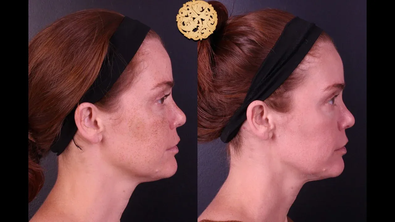 Microlaser Peel Before & After