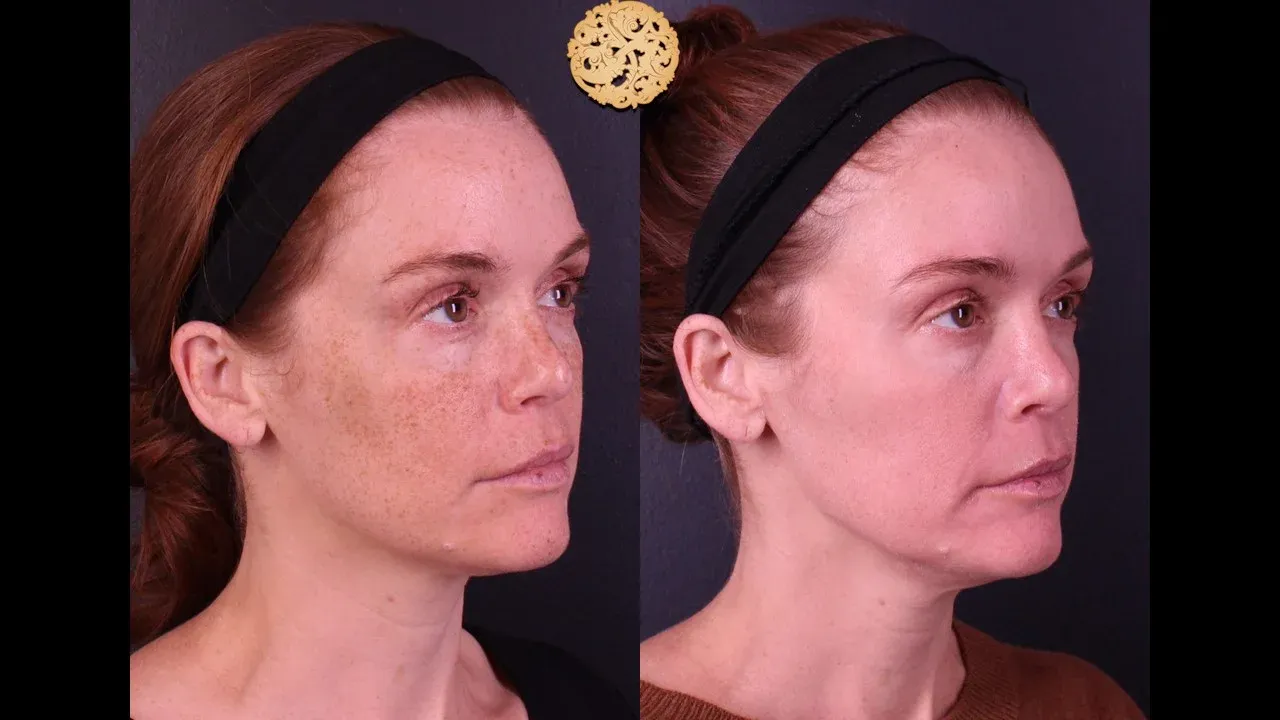 Microlaser Peel Before & After