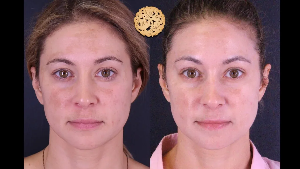 Microlaser Peel Before & After