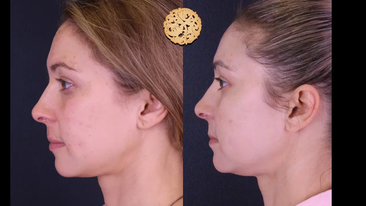 Microlaser Peel Before & After