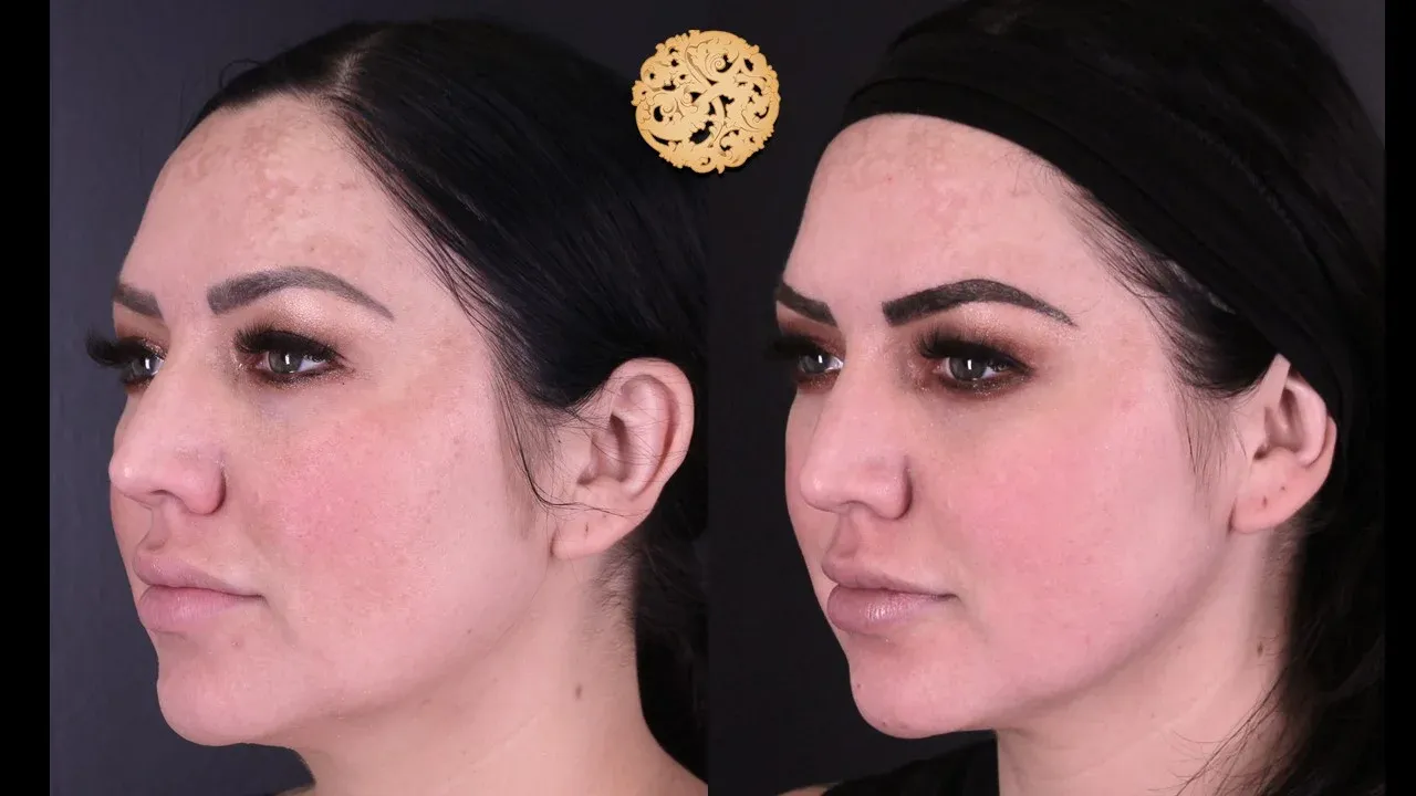 Microlaser Peel Before & After