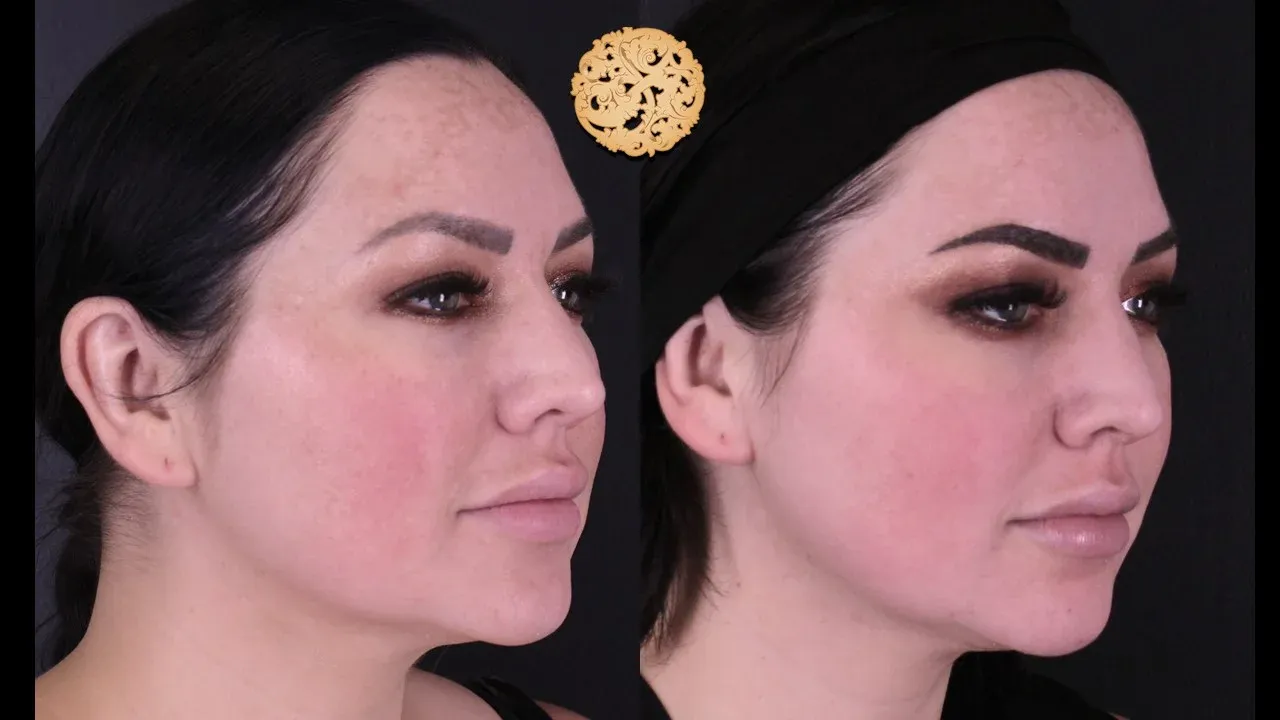 Microlaser Peel Before & After