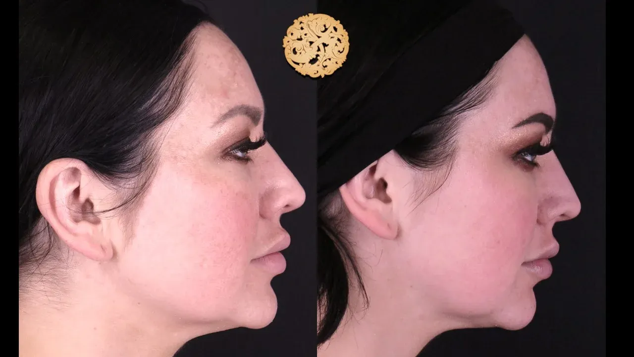 Microlaser Peel Before & After