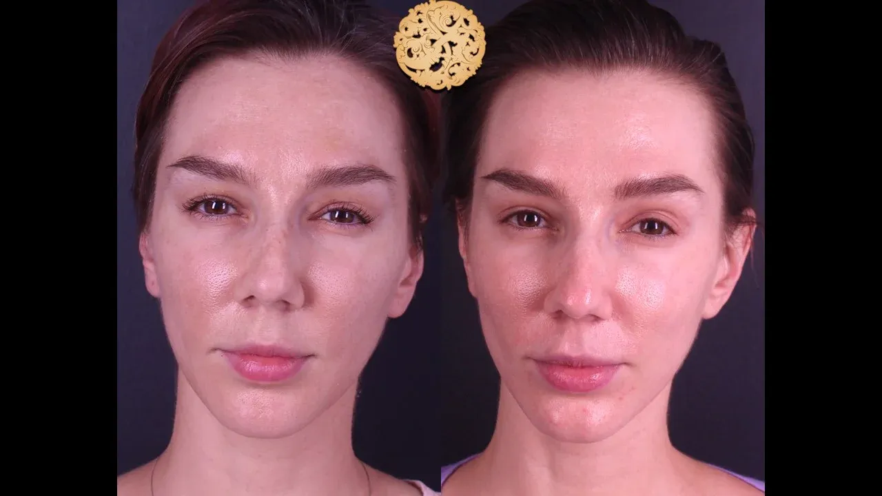 Microlaser Peel Before & After