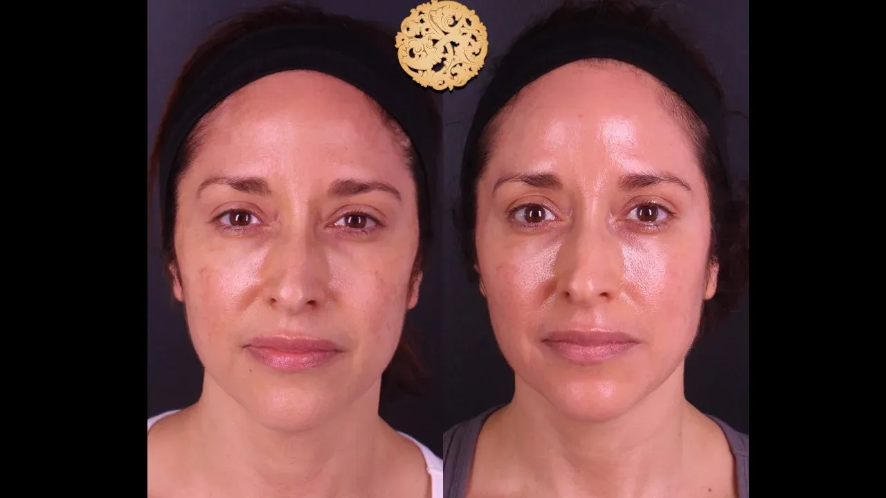 Microlaser Peel Before & After