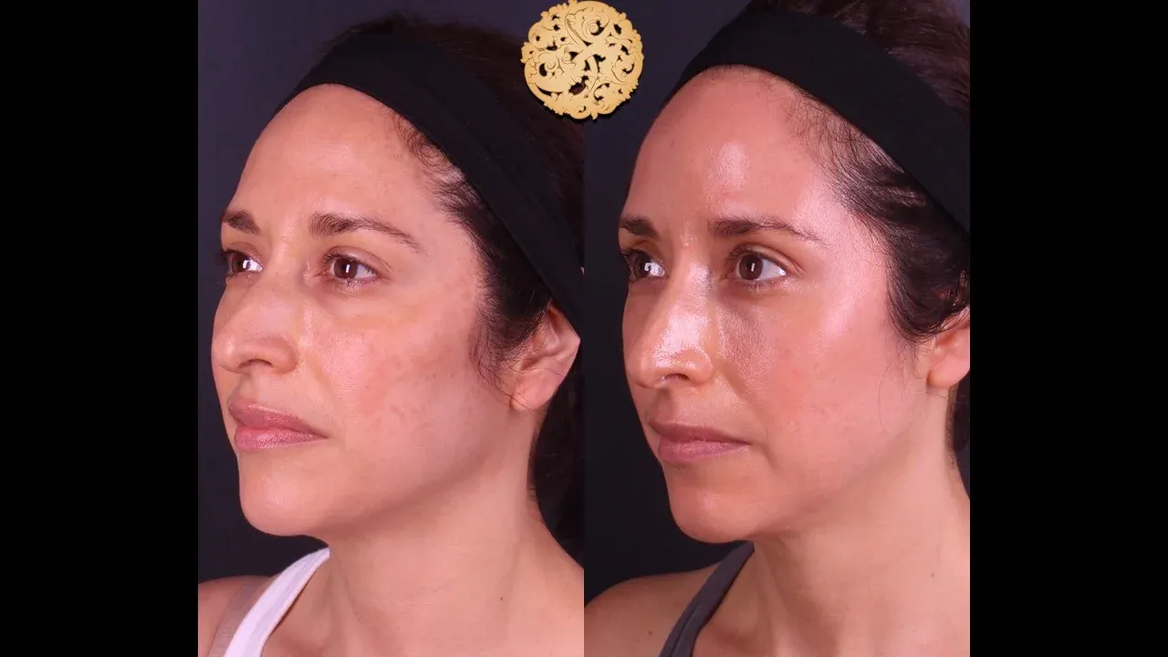 Microlaser Peel Before & After