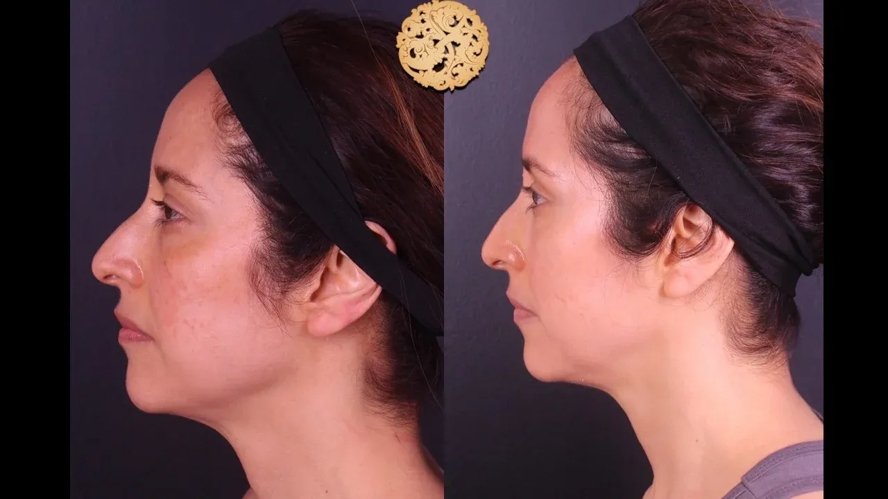 Microlaser Peel Before & After