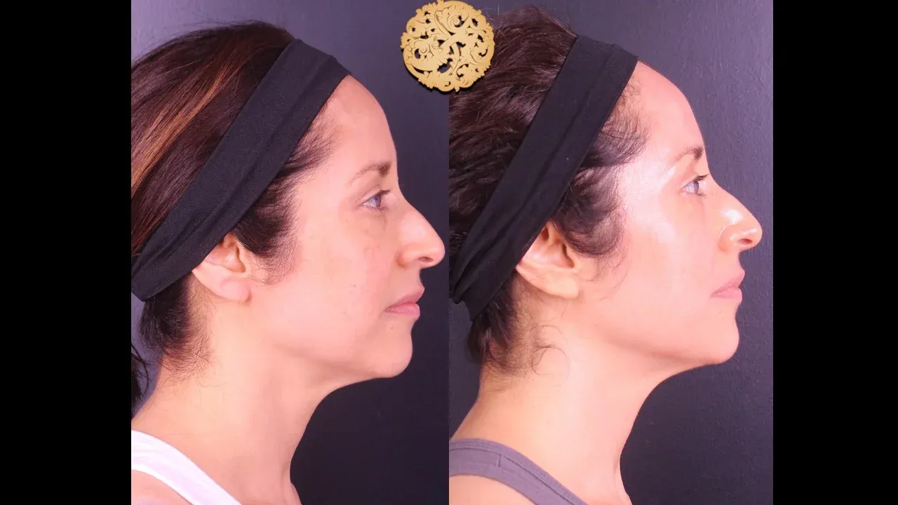 Microlaser Peel Before & After