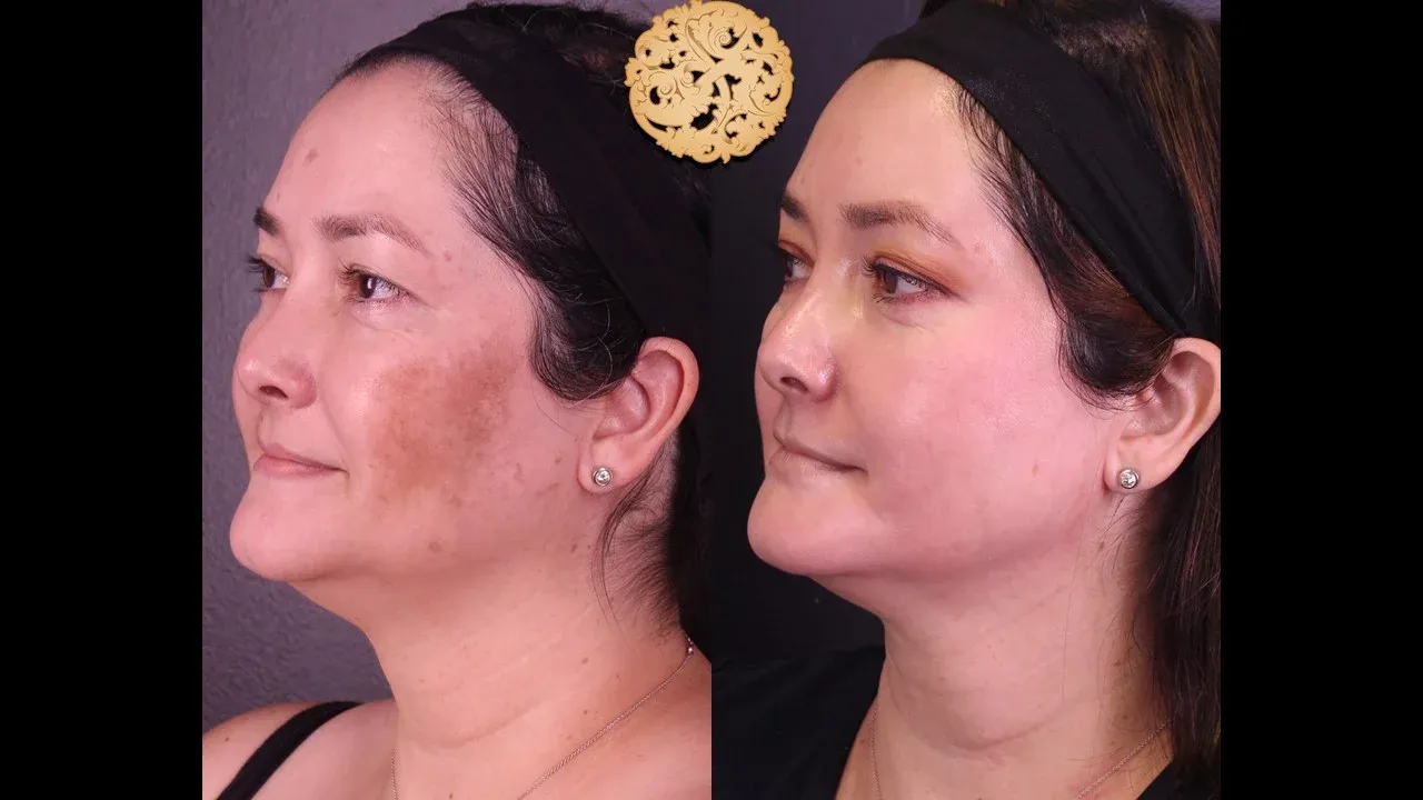 Microlaser Peel Before & After