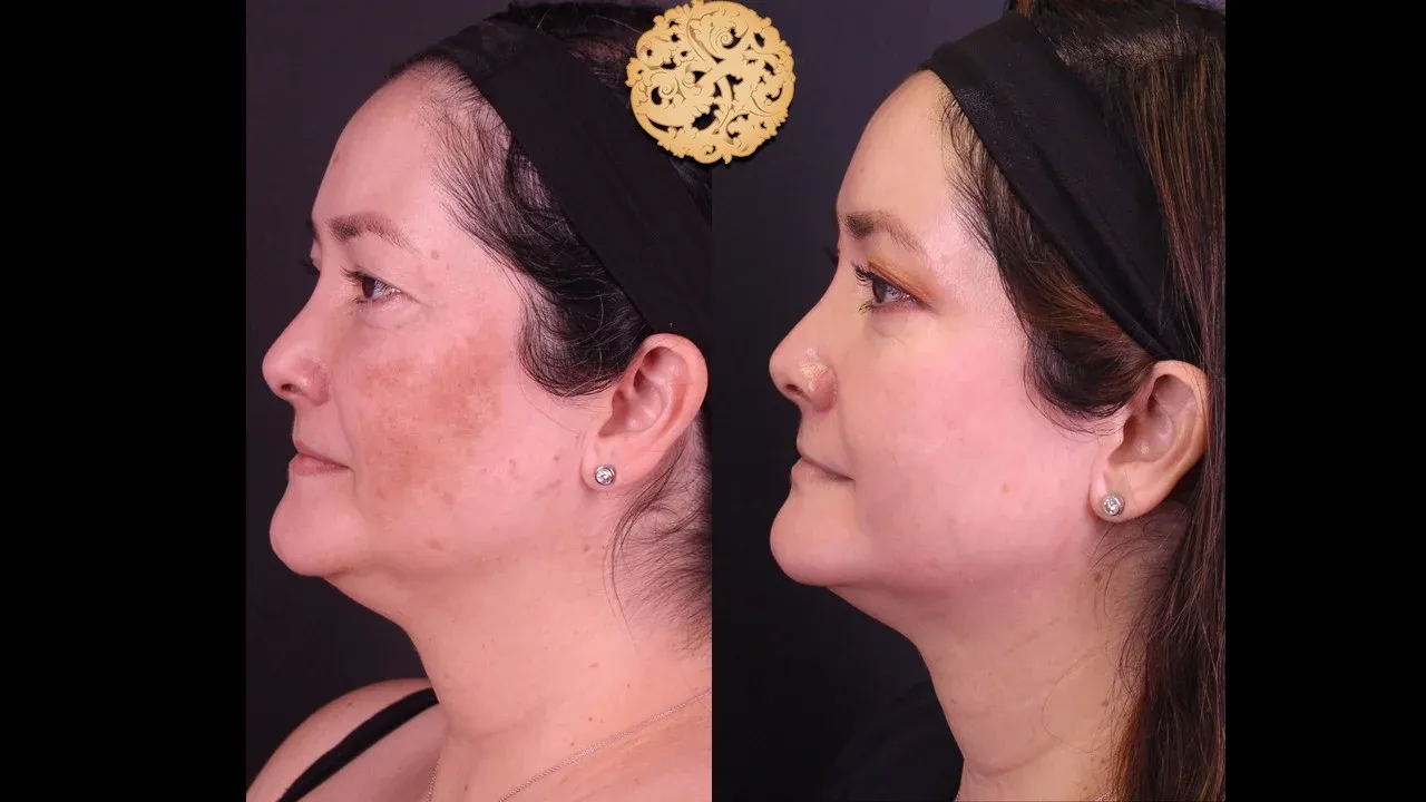 Microlaser Peel Before & After