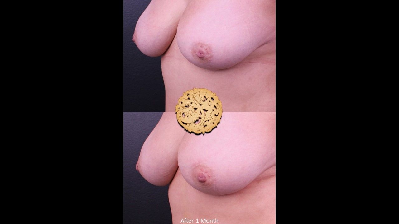 Inverted Nipple Repair Before & After