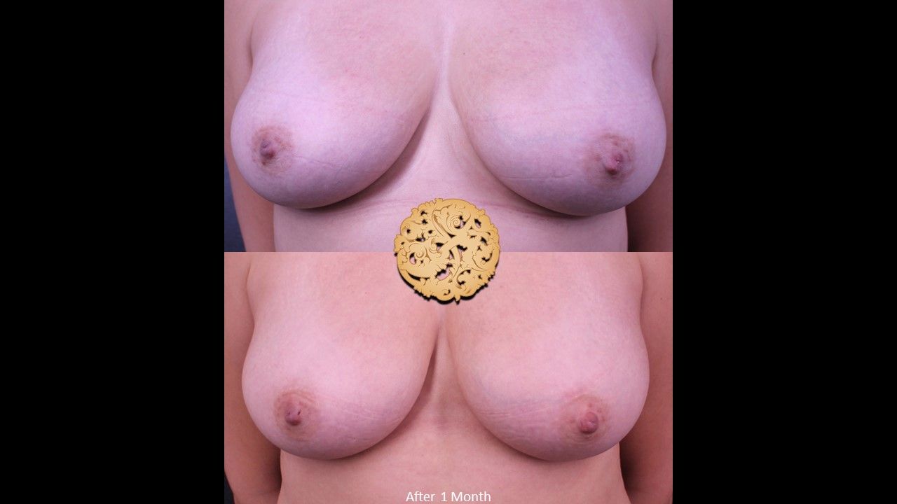 Inverted Nipple Repair Before & After