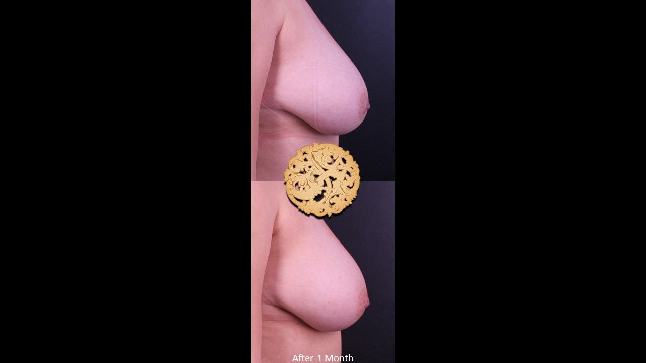 Inverted Nipple Repair Before & After