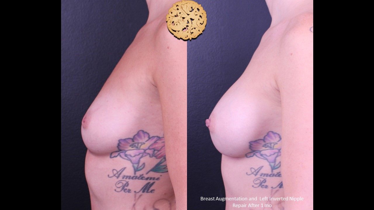 Inverted Nipple Repair Before & After
