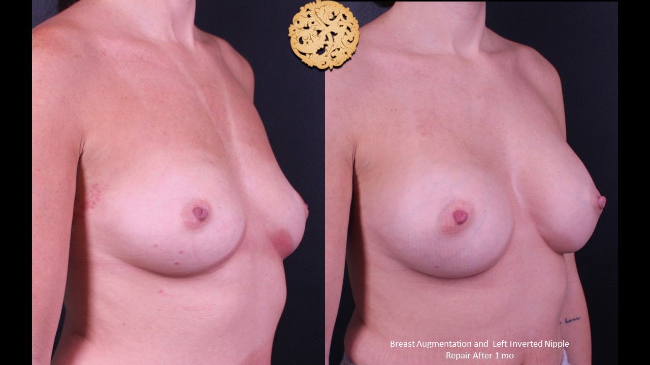 Inverted Nipple Repair Before & After