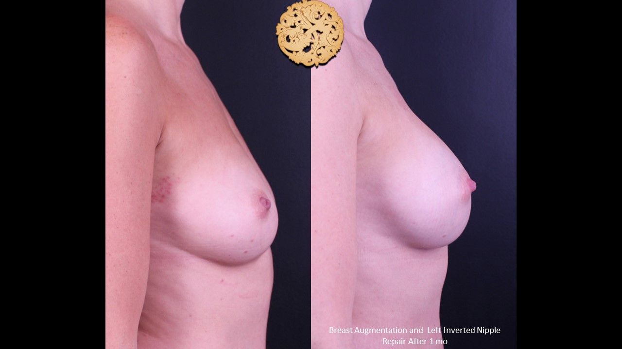 Inverted Nipple Repair Before & After