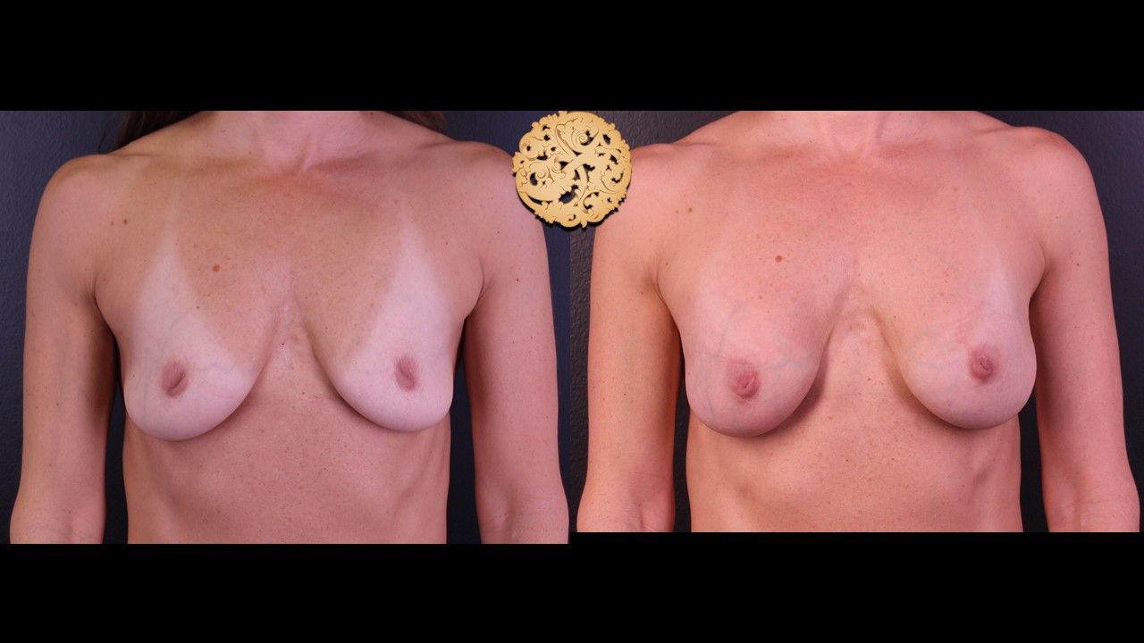 Inverted Nipple Repair Before & After