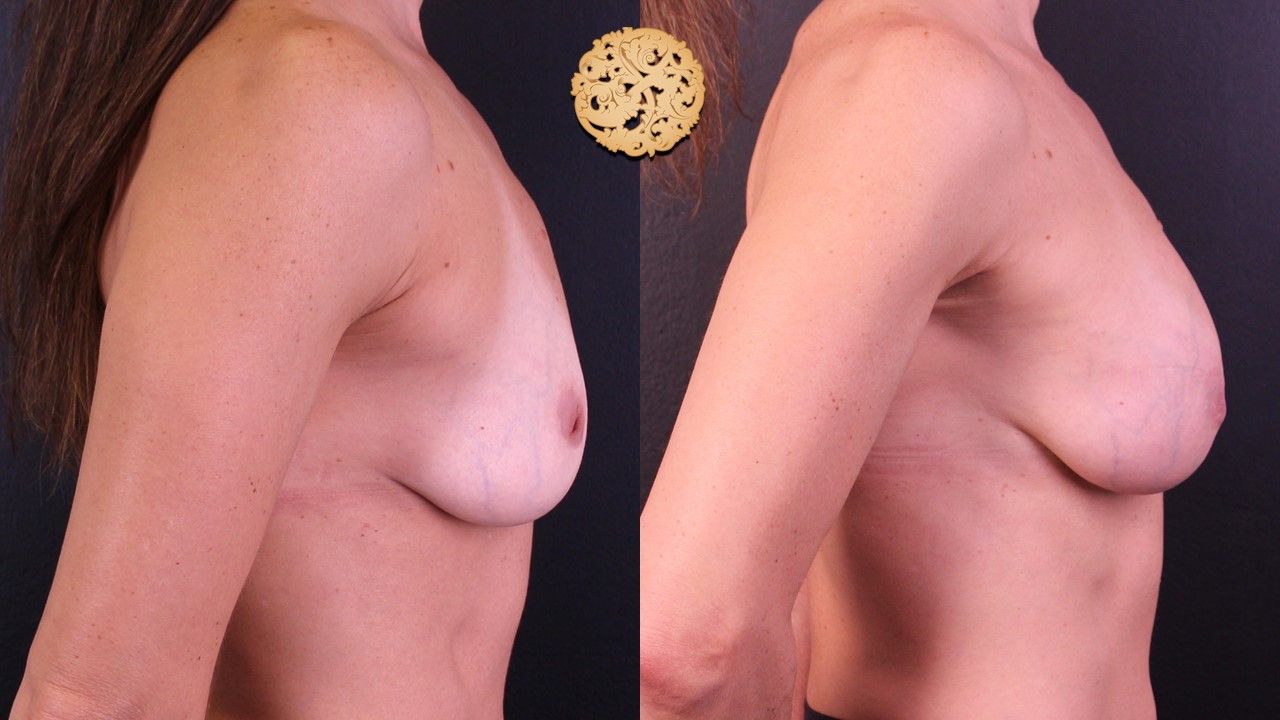 Inverted Nipple Repair Before & After