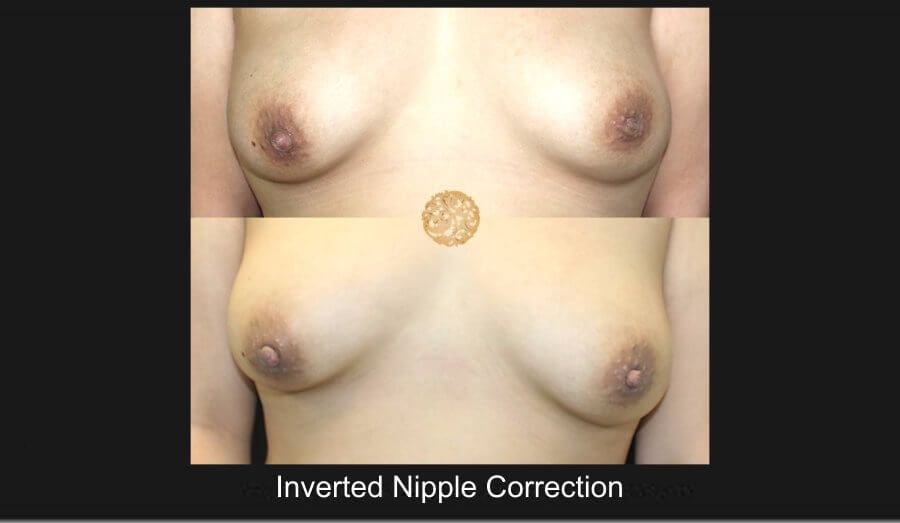 Inverted Nipple Repair Before & After