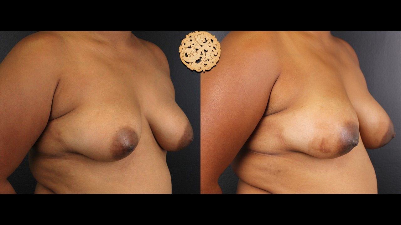 Inverted Nipple Repair Before & After