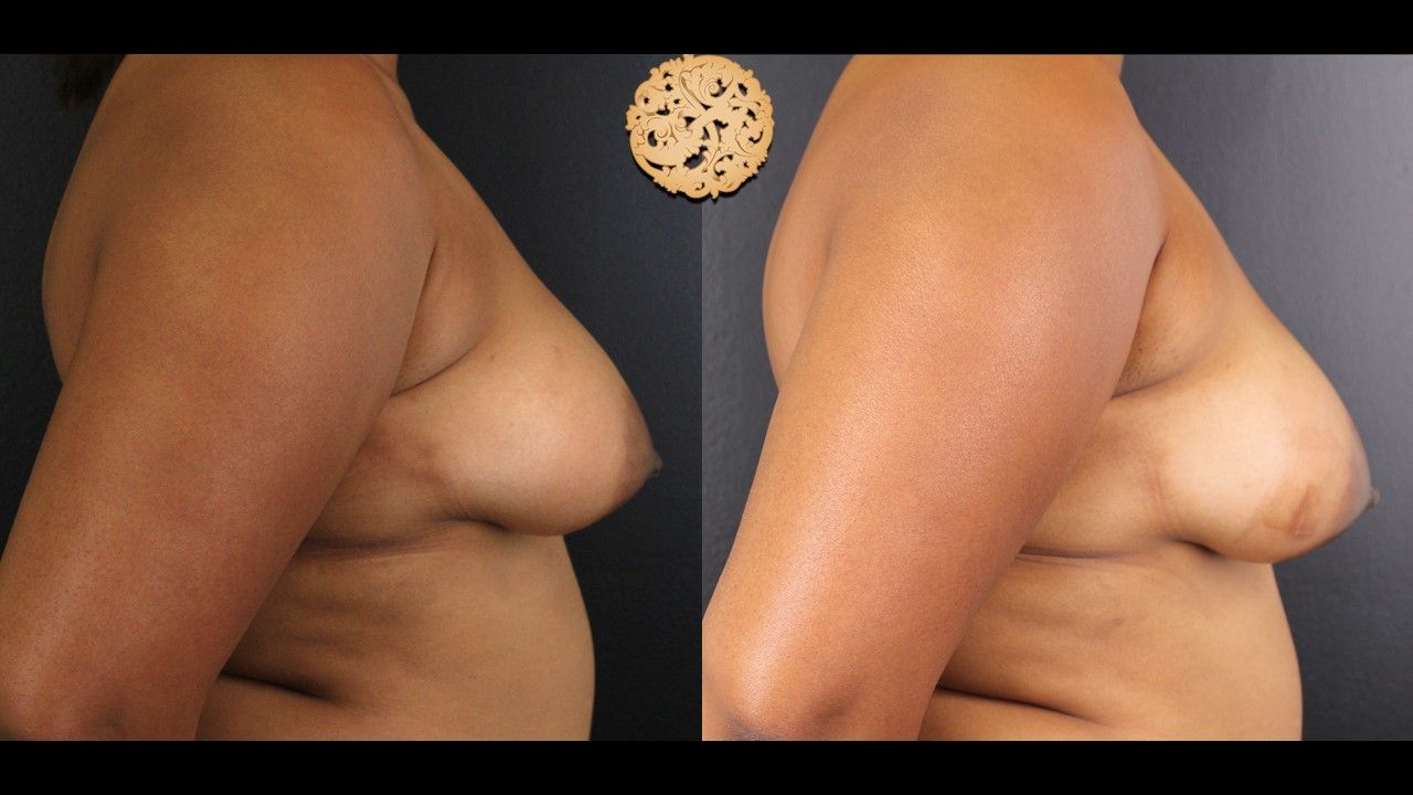 Inverted Nipple Repair Before & After