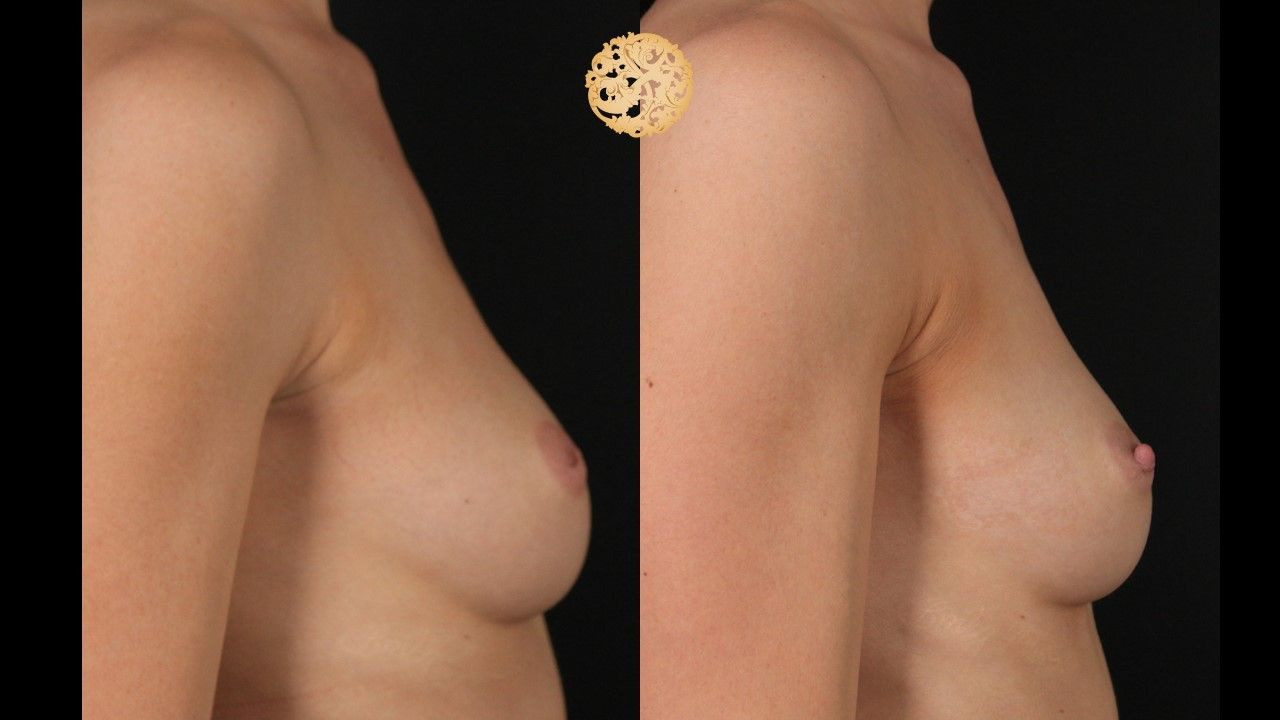Inverted Nipple Repair Before & After