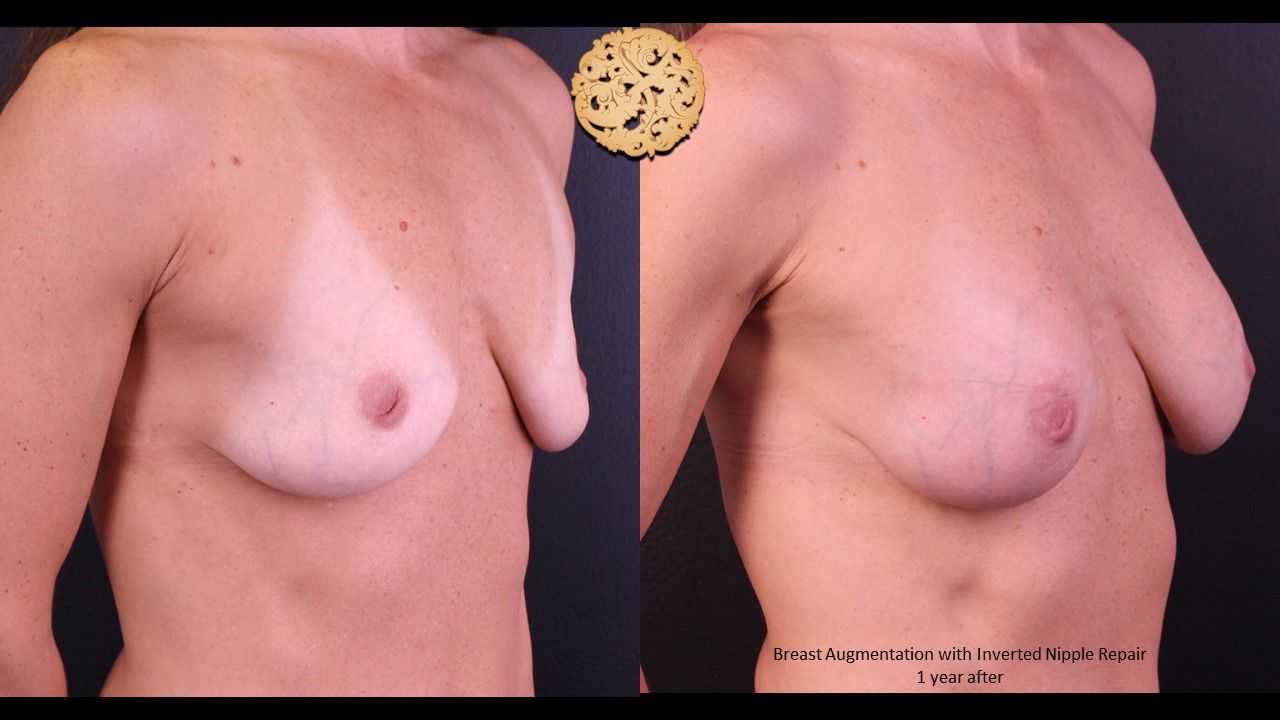 Inverted Nipple Repair Before & After