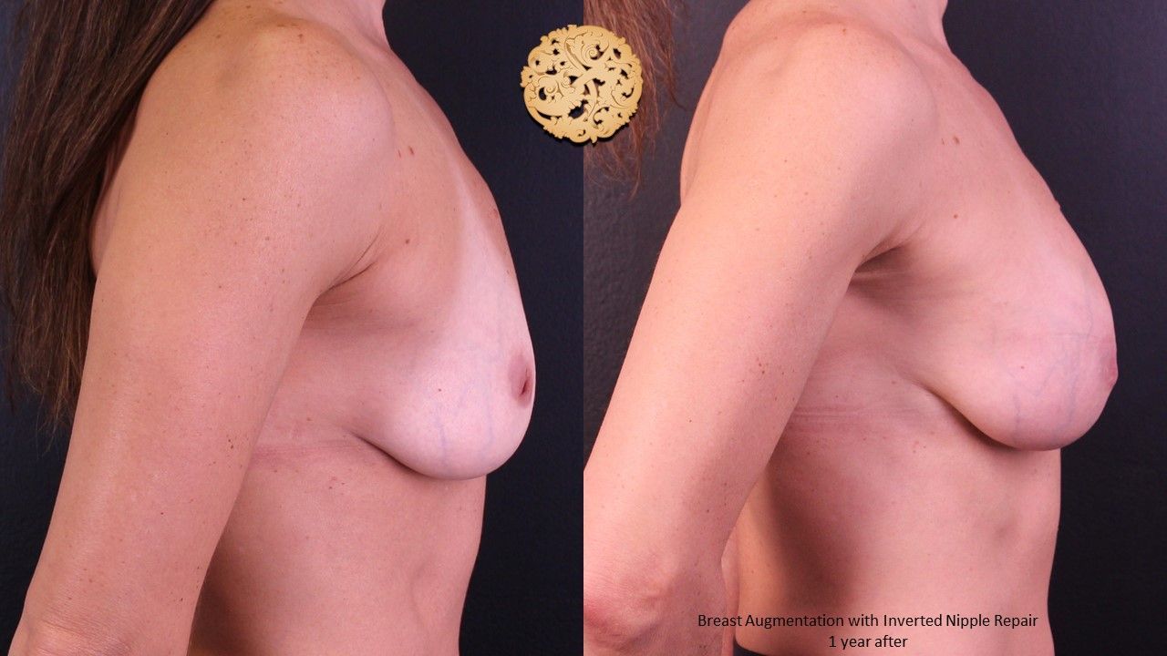 Inverted Nipple Repair Before & After