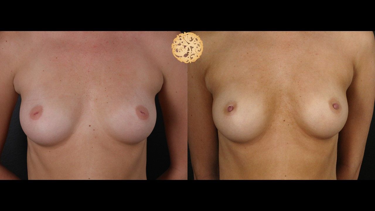 Inverted Nipple Repair Before & After