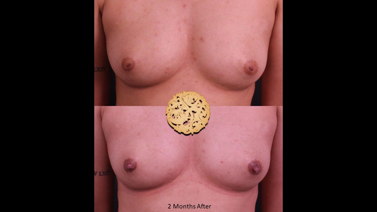 Inverted Nipple Repair Before & After