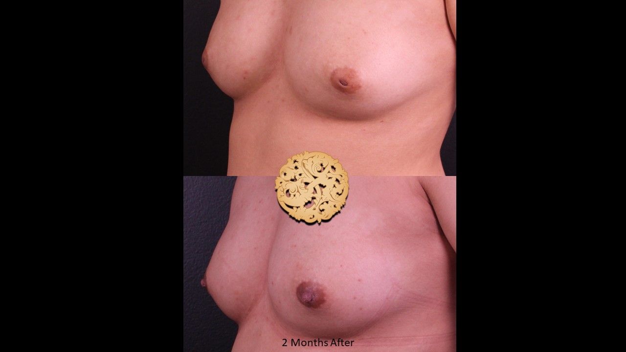 Inverted Nipple Repair Before & After