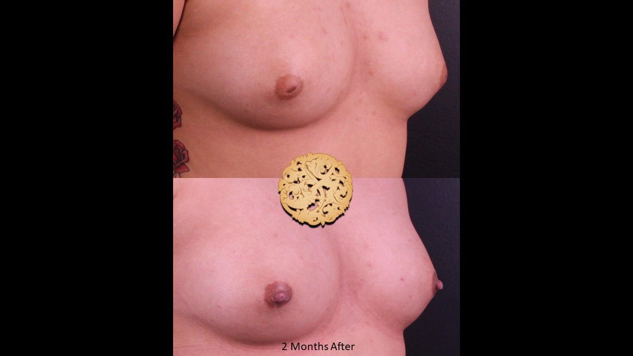 Inverted Nipple Repair Before & After