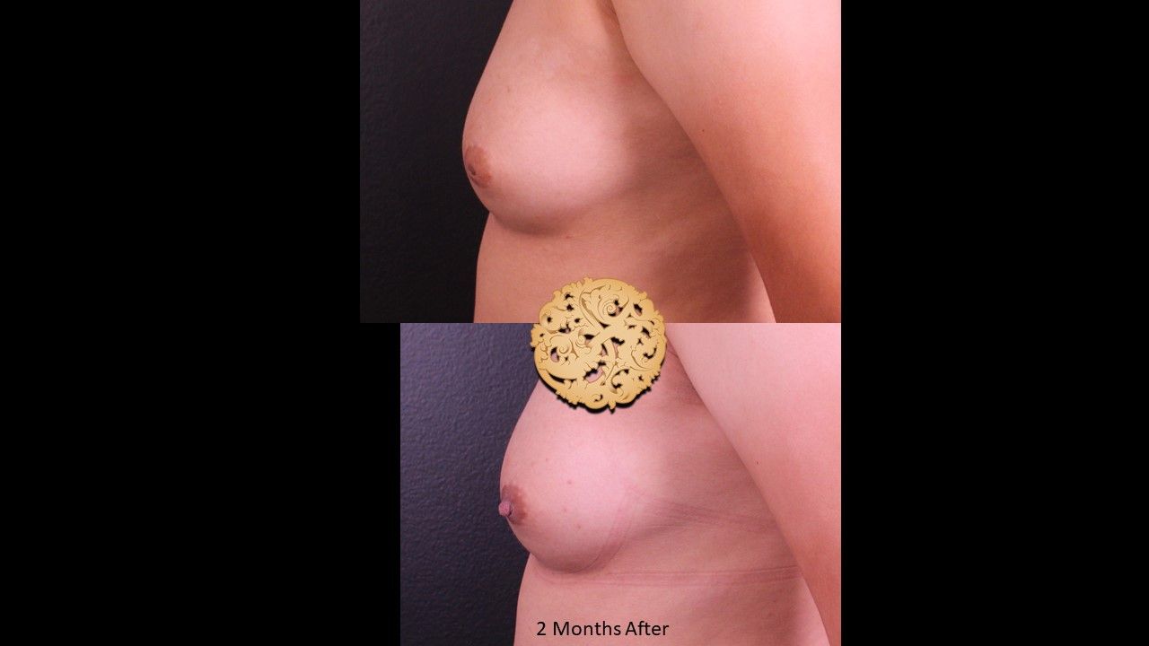 Inverted Nipple Repair Before & After
