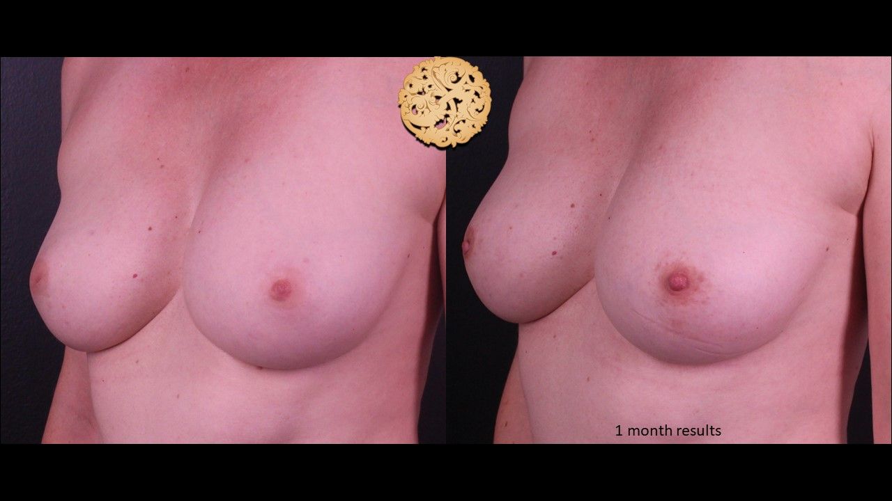 Inverted Nipple Repair Before & After