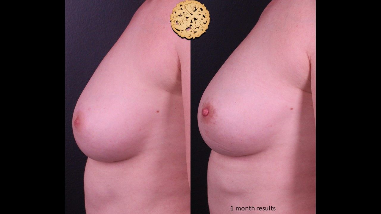 Inverted Nipple Repair Before & After