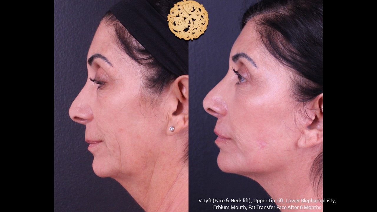 Lip Lift Before & After